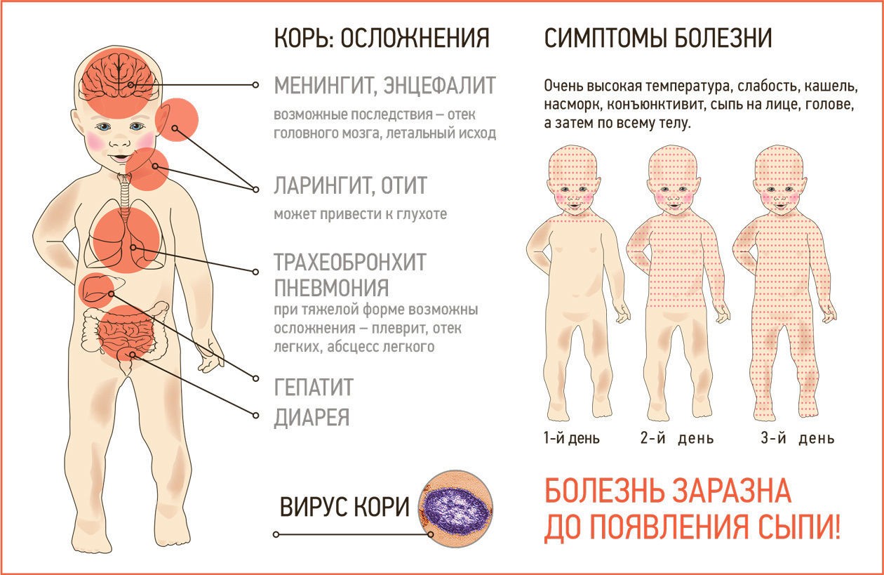 «Вероятность заразиться — 100%»: в регионах России — вспышки кори.